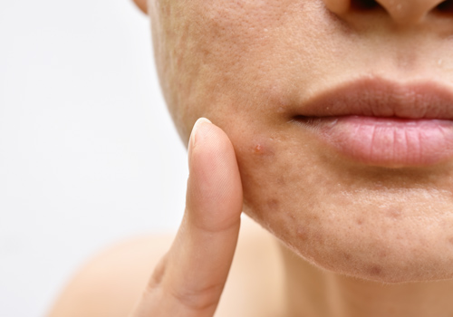 Close up of face with Acne